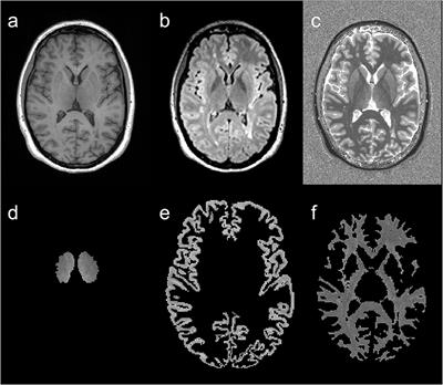 T1 Relaxation Times in the Cortex and Thalamus Are Associated With Working Memory and Information Processing Speed in Patients With Multiple Sclerosis